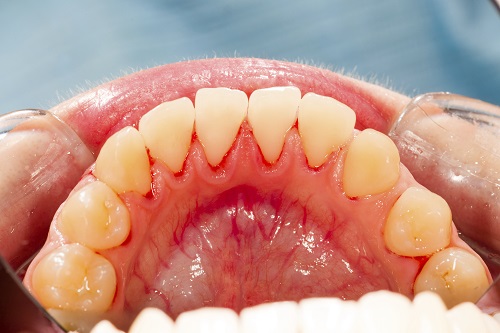 How Do You Get Gum Disease?