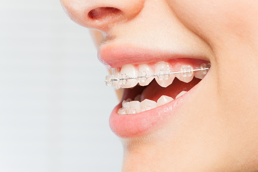 Which One is Better Between Invisalign and Braces?