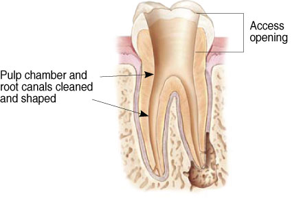 Diagram of tooth after pulp removal during a root canal procedure at Irvine Dentistry
