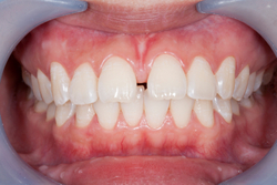 Close-up of white teeth without staining at Irvine Dentistry