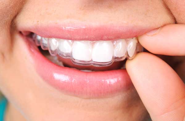 Invisalign Clear Braces in Irvine - Invisible Braces Irvine - Straight  Teeth Irvine