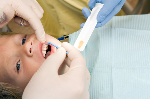 Young boy receiving fluoride treatment at Irvine Dentistry.